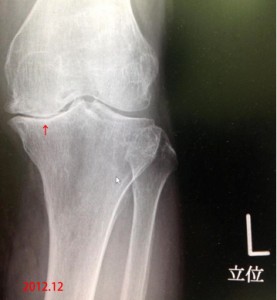 膝変化2012